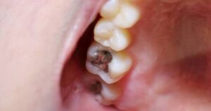 Leia mais sobre o artigo Sonhar com dentes podres significado